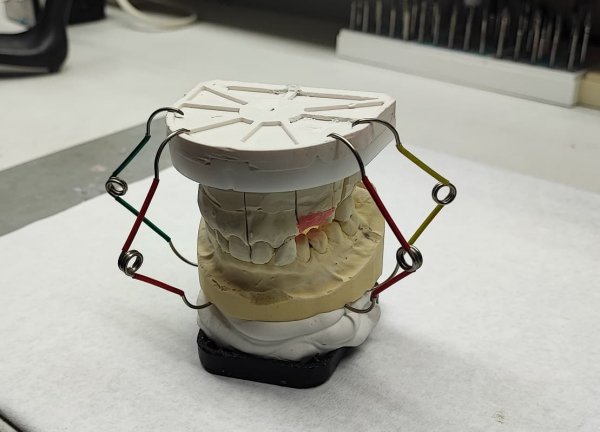 Artikulationsklammern (verstärkte Feder) - 5 Stück